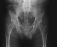 An X-ray following a symphysiotomy. Note the gap opened up in the pubic bone (circle) following the cutting of the connecting cartilege.